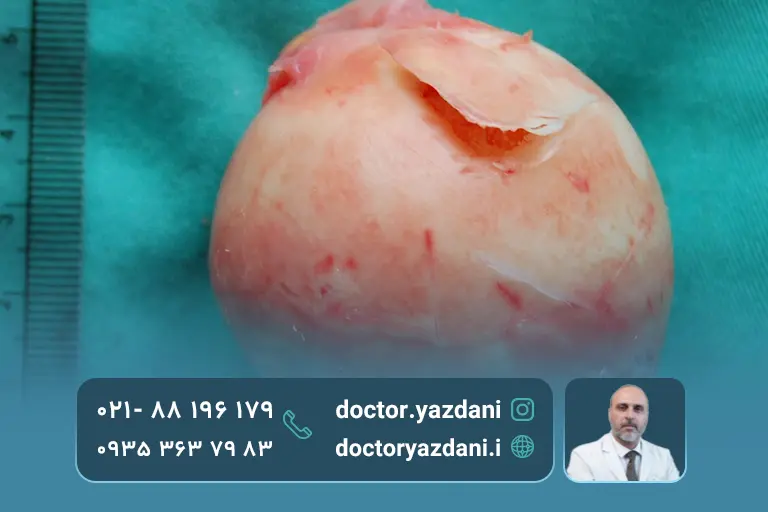 عکس نکروز آواسکولار